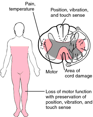 anterior cord syndrome