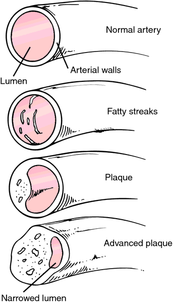 What is the definition of atherosclerosis?