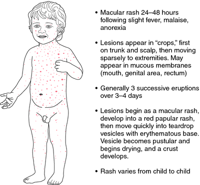 stages of poison ivy rash pictures. Chickenpox rash distribution.