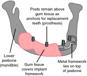 Equipoise dental