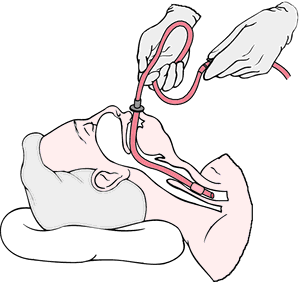 tube endotracheal suctioning et nasal definition medical lammon 1995 al