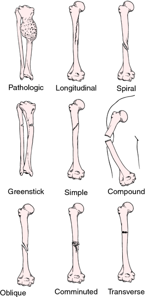 comminuted open fracture definition