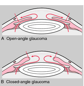 Open angle glaucoma steroids