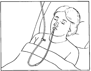 qfeed for tube feeding nares