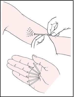 norplant contraceptive