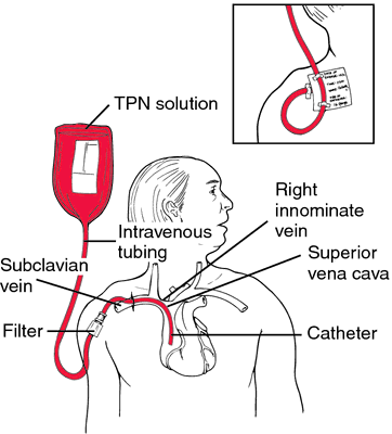 Tube Feeding Diet Definition And Origin