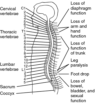 Tetraplegia | definition of tetraplegia by Medical dictionary