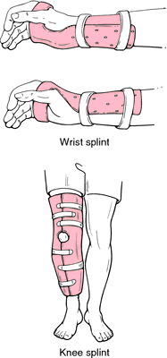 splints are also necessary to immobilize unset fracts when a