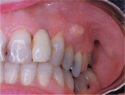 Periodontal Abscess