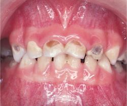 Tooth Caries Pictures