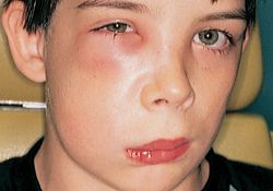 cellulitis of face