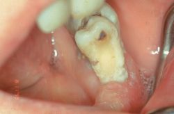 Biliary Calculus