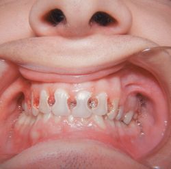 cavity tooth