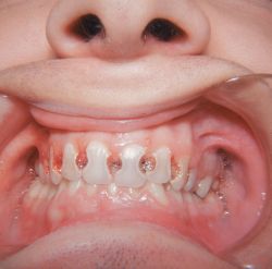 Tooth Caries Pictures