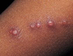 Celiacs Disease Rash