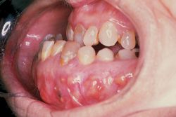 Cotton Mouth Disease