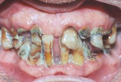 operculum dental