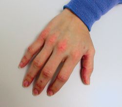 Is Dermatitis Contagious