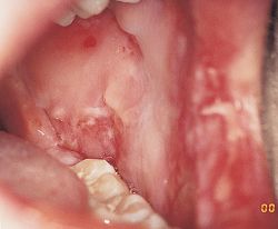 Erythema Multiforme Rash In Children