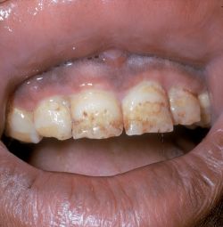 Calcification On Teeth