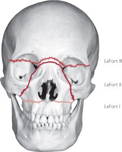 Fractured Zygomatic Bone