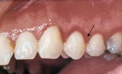 Linear Marginal Erythema