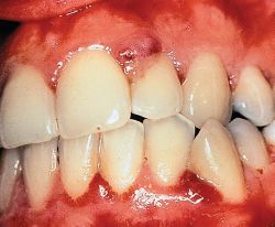 Gingivitis Images