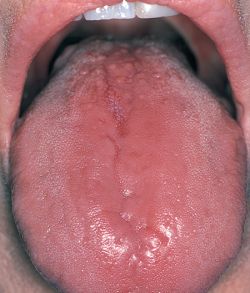 burns on tongue