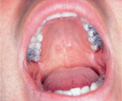 Throat Ulcer Photos
