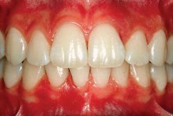 Periodontal Disease Definition