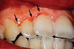 gingival margin