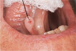 oral keratosis