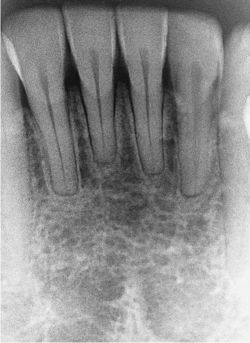 Alveolar Bone Resorption