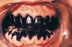Black Stain Teeth