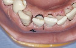 transverse palatine suture