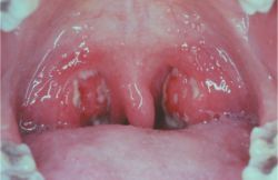 image of tonsillitis