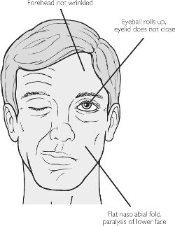 Bell's palsy - definition of Bell's palsy in the Medical ...