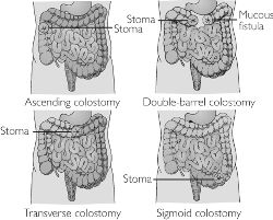 What is a diverting colostomy?