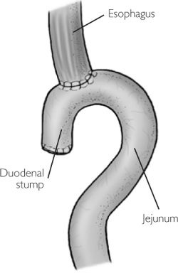 Gastrectomy.