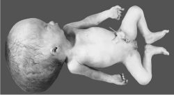 Fetal Hydrocephalus