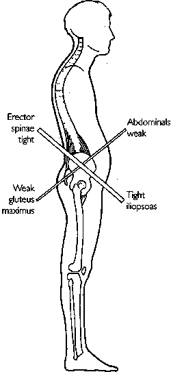 pelvic crossed syndrome.