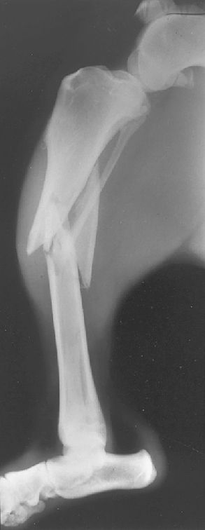 comminuted open fracture