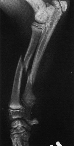Closed Simple Fracture