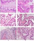 Histopathology of seromucinous borderline tumors.jpg