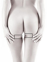 Horizontal gluteal crease.jpg