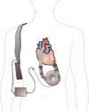 Ventricular assist device.png