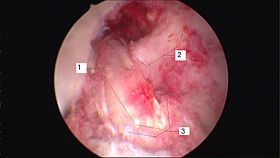 Anterior cruciate ligament repair 3 legend.jpg