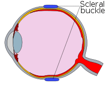 Diagram of an eye with a scleral buckle, in cross-section.