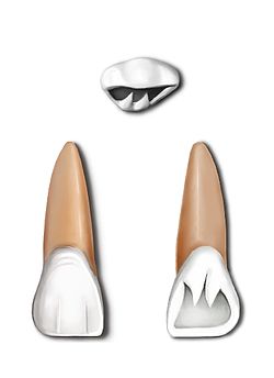 Maxillary central incisor.jpg