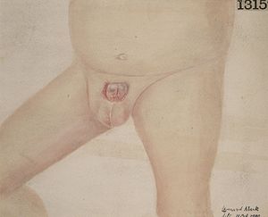 Epispadias in a boy aged two years Wellcome L0062463.jpg